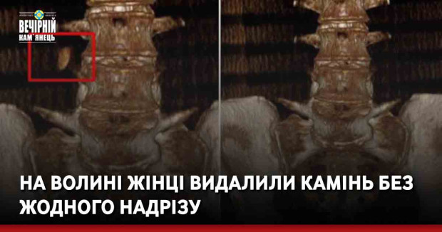 На Волині жінці видалили камінь без жодного надрізу