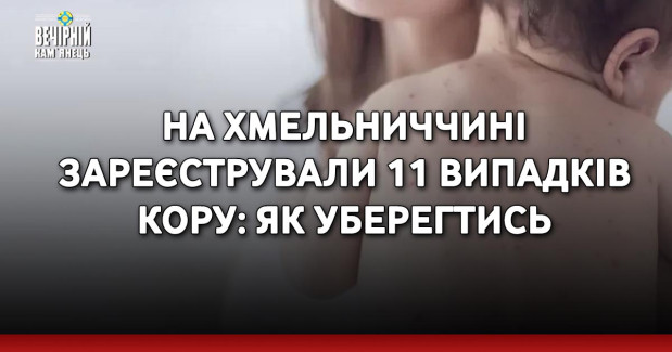 На Хмельниччині зареєстрували 11 випадків кору: як уберегтись