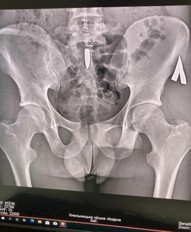 складна операція